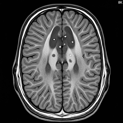 Detailed MRI scan of the human brain with highlighted lesions, indicating Multiple Sclerosis